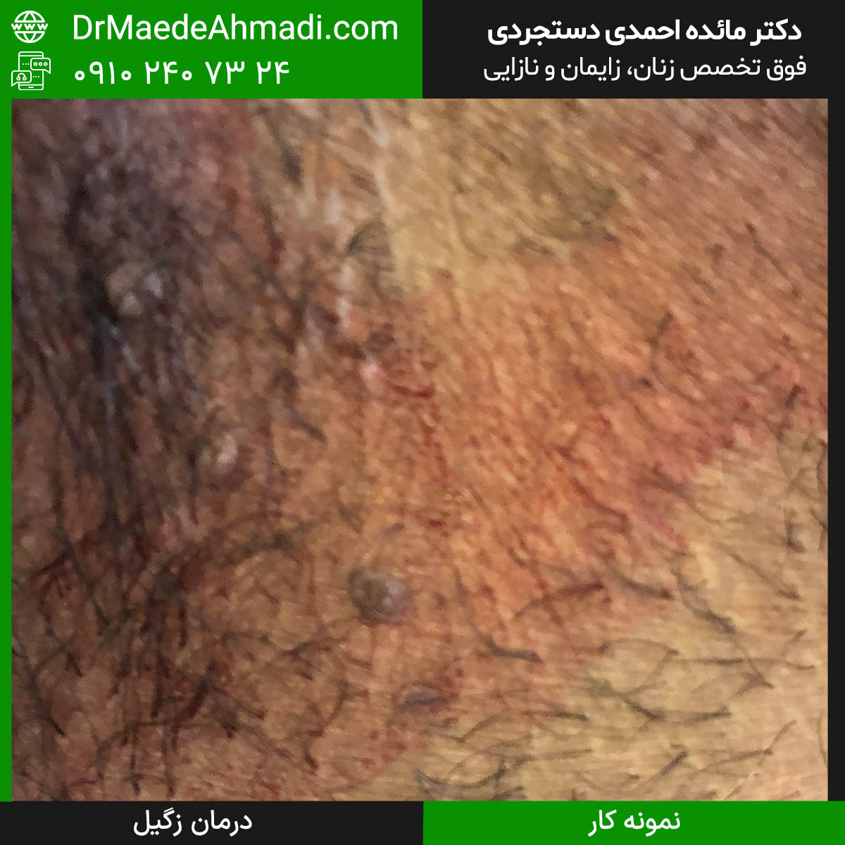 راه‌های درمان زگیل تناسلی در زنان