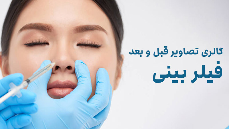 گالری تصاویر قبل و بعد فیلر بینی