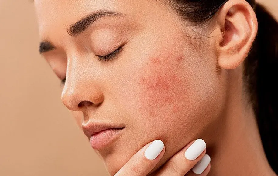 جوش‌های هورمونی