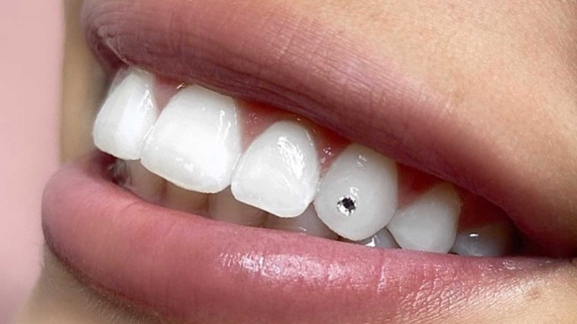 یکی از روش‌های زیبایی دندان با کاشت نگین دندان
