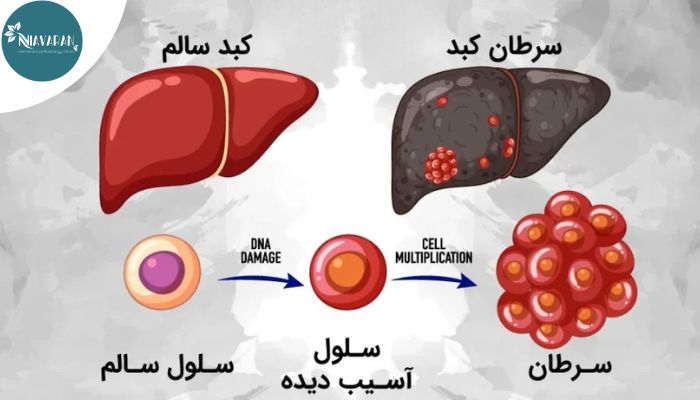 بهترین جایگزینهای پیوند کبدی چیست؟ بررسی روش های نوین