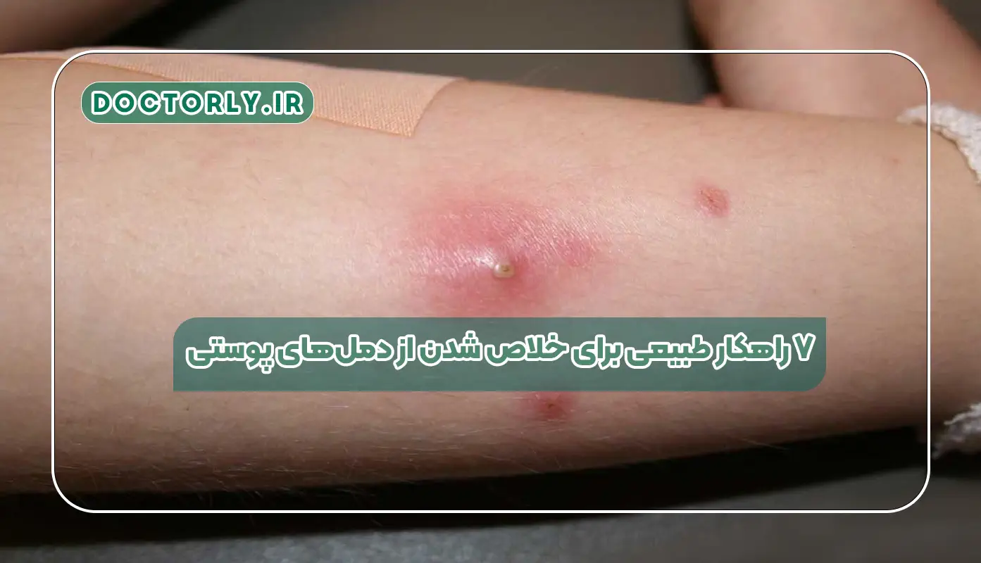 ۷ راهکار طبیعی برای خلاص شدن از دمل‌های پوستی