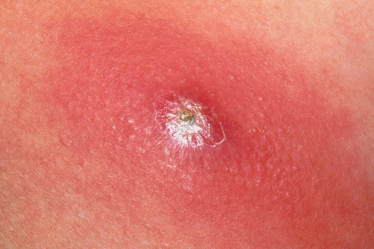 چگونه از بروز کورک جلوگیری کنیم؟